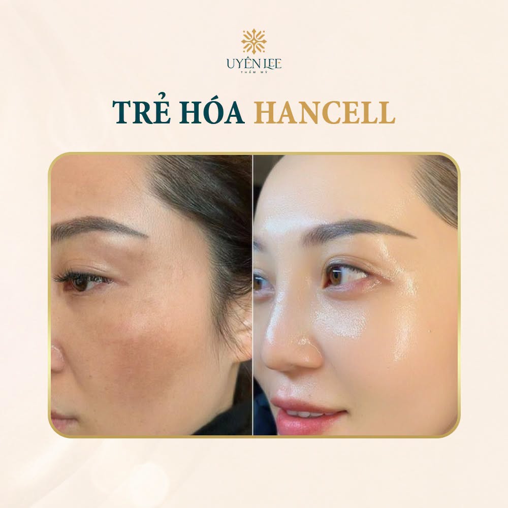 Trẻ hóa Hancell làn da đẹp - COMBO BA CHẠM RẠNG NGỜI