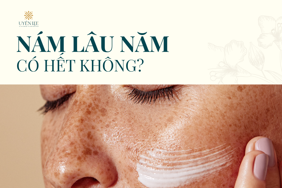 NÁM LÂU NĂM CÓ HẾT KHÔNG? Đang là nổi lo lắng của hàng triệu phụ nữ