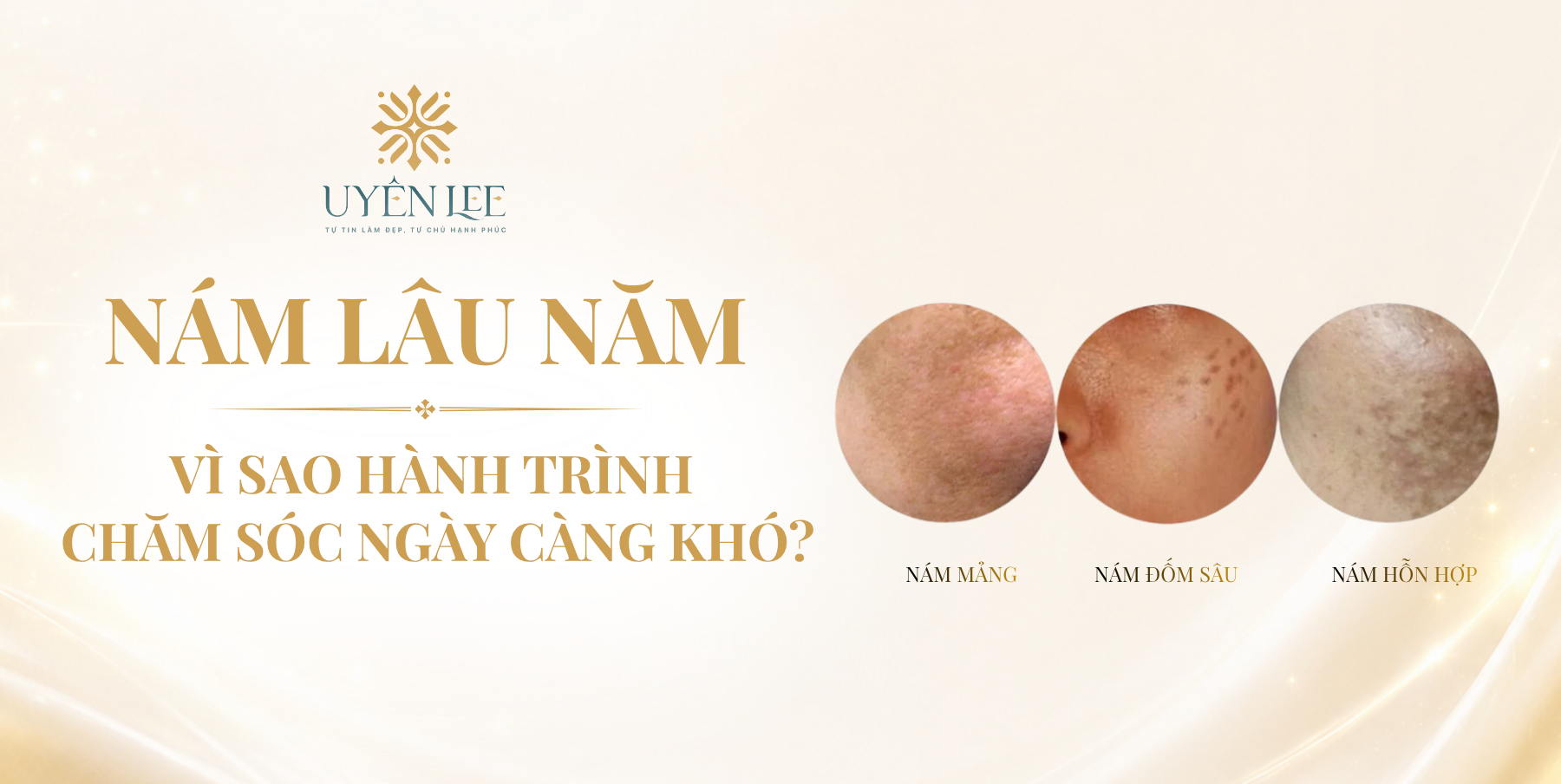 Nám lâu năm – vì sao hành trình chăm sóc ngày càng khó?