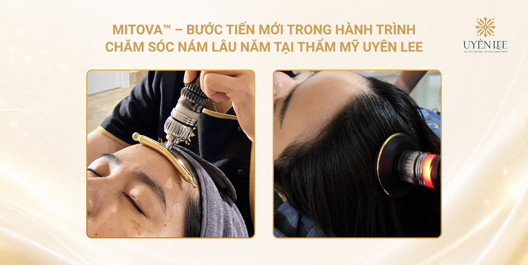MITOVA™ – Bước tiến mới trong hành trình chăm sóc nám